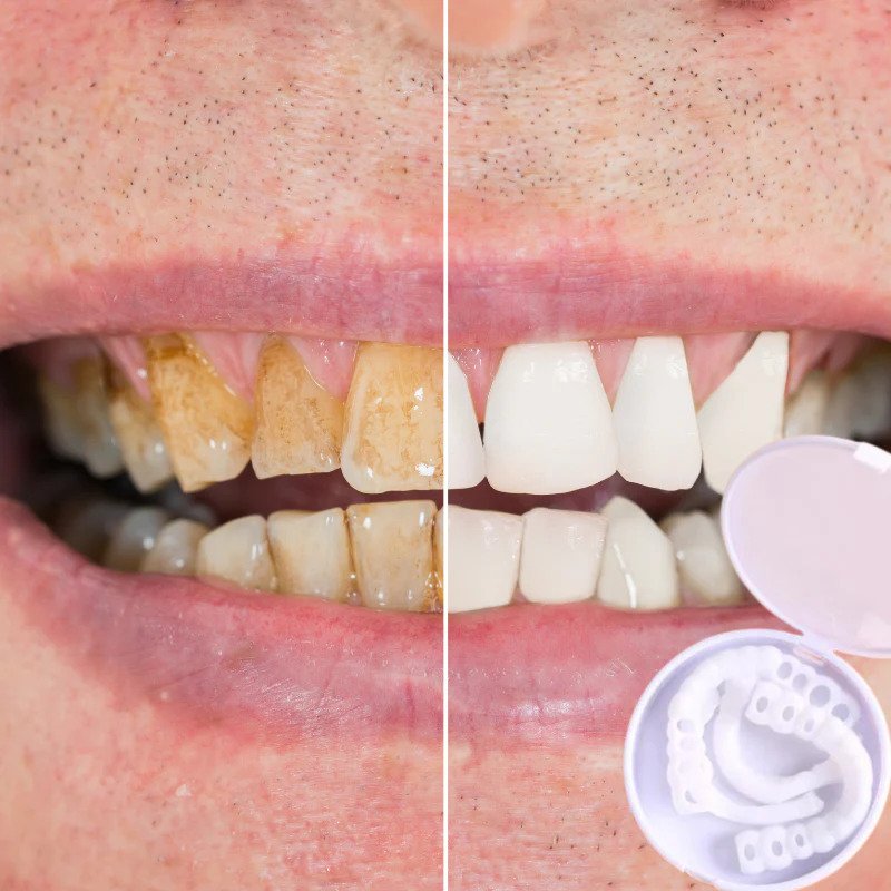 Chic and Style | SmileSnap - Always the perfect smile with these veneers