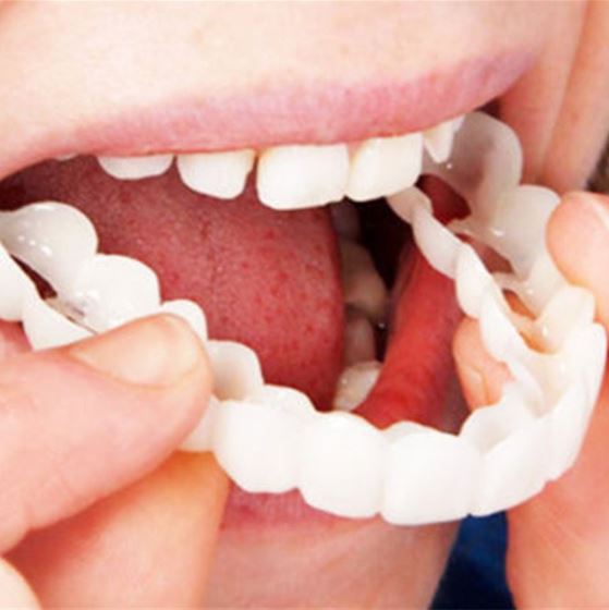 Chic and Style | SmileSnap - Always the perfect smile with these veneers